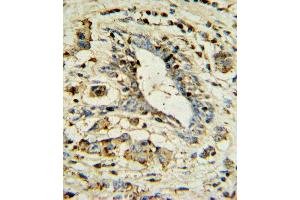 OL1 Antibody 7361a IHC analysis in formalin fixed and paraffin embedded human breast carcinoma followed by peroxidase conjugation of the secondary antibody and DAB staining. (APOL1 anticorps  (AA 137-171))