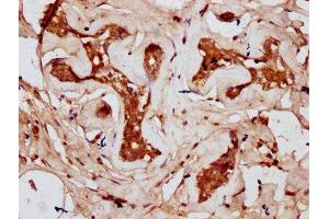 IHC image of ABIN7148040 diluted at 1:300 and staining in paraffin-embedded human breast cancer performed on a Leica BondTM system. (Codanin 1 (CDNA1) (AA 62-249) anticorps)