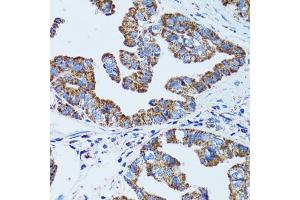 Immunohistochemistry of paraffin-embedded human gastric cancer using GIP antibody. (GIP anticorps)