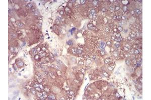 Immunohistochemical analysis of paraffin-embedded liver cancer tissues using NFKBIA mouse mAb with DAB staining.