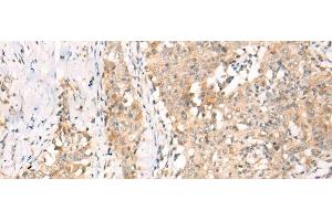 Immunohistochemistry of paraffin-embedded Human esophagus cancer tissue using YRDC Polyclonal Antibody at dilution of 1:30(x200) (YRDC anticorps)