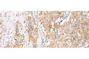 Immunohistochemistry of paraffin-embedded Human esophagus cancer tissue using YRDC Polyclonal Antibody at dilution of 1:30(x200)