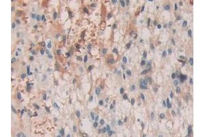 Detection of SHC3 in Human Glioma Tissue using Polyclonal Antibody to SHC-Transforming Protein 3 (SHC3)