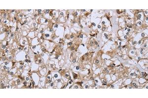 Immunohistochemistry of paraffin-embedded Human prostate cancer using CD32 Polyclonal Antibody at dilution of 1:40 (Fc gamma RII (CD32) anticorps)