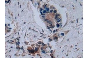Detection of C2CD3 in Human Breast cancer Tissue using Polyclonal Antibody to C2 Calcium Dependent Domain Containing Protein 3 (C2CD3) (C2CD3 anticorps  (AA 1432-1647))