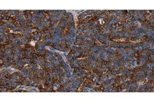 Immunohistochemistry of paraffin-embedded Human ovarian cancer using HMGCL Polyclonal Antibody at dilution of 1:30