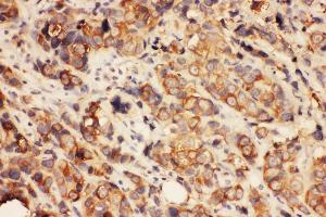 Anti-HDAC2 antibody,  IHC(P) IHC(P): Human Mammary Cancer Tissue (HDAC2 anticorps  (C-Term))