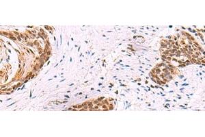 Immunohistochemistry of paraffin-embedded Human esophagus cancer tissue using CREBBP Polyclonal Antibody at dilution of 1:35(x200)