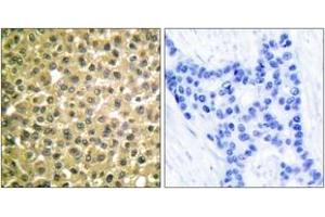 Immunohistochemistry analysis of paraffin-embedded human breast carcinoma tissue, using Retinoic Acid Receptor beta Antibody. (Retinoic Acid Receptor beta anticorps  (AA 331-380))