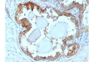 Formalin-fixed, paraffin-embedded human Prostate Carcinoma stained with HSP27 Monoclonal Antibody (G3.