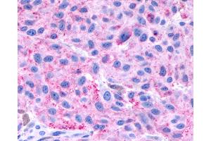 Anti-NPBWR1 / GPR7 antibody IHC of human Skin, Melanoma.