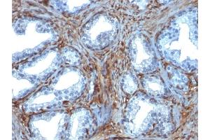 Formalin-fixed, paraffin-embedded human Prostate Carcinoma stained with Galectin-1 Monospecific Mouse Monoclonal Antibody (GAL1/1831).