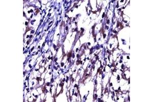 OPG antibody immunohistochemistry analysis in formalin fixed and paraffin embedded human kidney carcinoma.