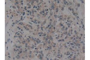 IHC-P analysis of Human Prostate cancer Tissue, with DAB staining. (NUP153 anticorps  (AA 1238-1468))