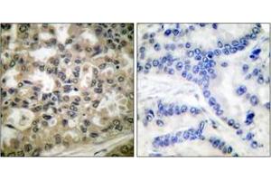 Immunohistochemistry analysis of paraffin-embedded human lung carcinoma, using IkappaB-beta (Phospho-Ser23) Antibody. (NFKBIB anticorps  (pSer23))