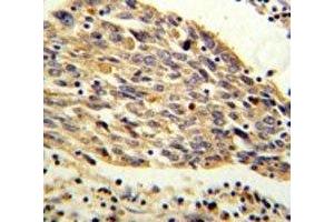 PKM2 antibody IHC analysis in formalin fixed and paraffin embedded human lung carcinoma. (PKM2 anticorps  (AA 116-145))