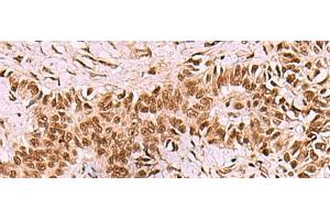 Immunohistochemistry of paraffin-embedded Human ovarian cancer tissue using LDB1 Polyclonal Antibody at dilution of 1:70(x200) (LIM Domain Binding 1 Protein anticorps)