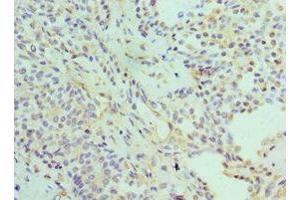 Immunohistochemistry of paraffin-embedded human breast cancer using ABIN7142216 at dilution of 1:100 (PSMD5 anticorps  (Regulatory Subunit 5))