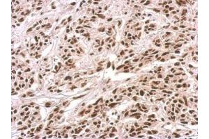 IHC-P Image PUF60 antibody detects PUF60 protein at nucleus on U251 xenograft by immunohistochemical analysis.
