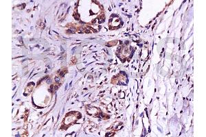 Formalin-fixed and paraffin embedded human gastric carcinoma labeled with Anti-CD105 Polyclonal Antibody (ABIN670401), Unconjugated at 1:200, followed by conjugation to the secondary antibody and DAB staining (Endoglin anticorps  (AA 601-658))