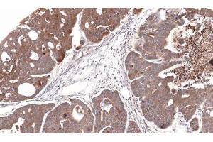 IHC-P Image Immunohistochemical analysis of paraffin-embedded Gastric CA N87 xenograft, using CDA, antibody at 1:100 dilution.