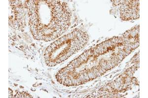 IHC-P Image Immunohistochemical analysis of paraffin-embedded human colon carcinoma, using EIF2B beta, antibody at 1:250 dilution. (eIF2B beta (Center) anticorps)