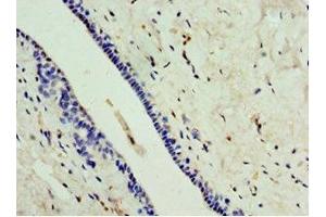 Immunohistochemistry of paraffin-embedded human breast cancer using ABIN7146735 at dilution of 1:100 (CA8 anticorps  (AA 1-290))