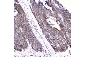 IHC testing of FFPE human esophageal squamous cell carcinoma with FABP3 antibody at 2ug/ml. (FABP3 anticorps  (AA 2-133))
