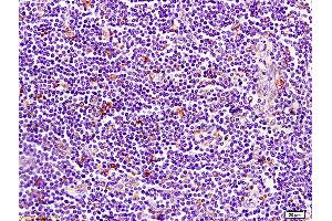 Formalin-fixed and paraffin embedded human pancreatic cancer tissue labeled with Anti-CD1A Polyclonal Antibody, Unconjugated (ABIN702700) at 1:200 followed by conjugation to the secondary antibody and DAB staining (CD1d1 anticorps  (AA 51-150))