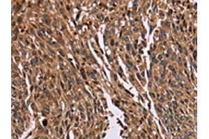 The image on the left is immunohistochemistry of paraffin-embedded Human lung cancer tissue using ABIN7129718(HMGN5 Antibody) at dilution 1/20, on the right is treated with fusion protein. (HMGN5 anticorps)