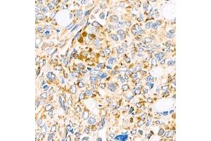Immunohistochemistry analysis of paraffin-embedded human ovary cancer using Torsin A (ABIN7075942) at dilution of 1:800