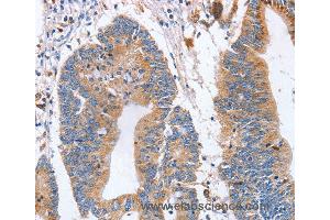 Immunohistochemistry of Human colon cancer using SIGLEC6 Polyclonal Antibody at dilution of 1:70 (SIGLEC6 anticorps)