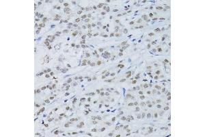 Immunohistochemistry of paraffin-embedded human colon carcinoma using SNRNP70 antibody.