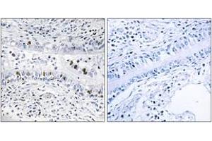 Immunohistochemistry analysis of paraffin-embedded human lung carcinoma tissue, using EZH1 Antibody. (EZH1 anticorps  (AA 171-220))