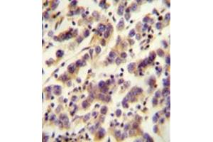 Immunohistochemistry analysis in formalin fixed and paraffin embedded human testis carcinoma reacted with OR1J4 Antibody (C-term) followed which was peroxidase conjugated to the secondary antibody and followed by DAB staining. (OR1J4 anticorps  (C-Term))