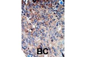 Formalin-fixed and paraffin-embedded human cancer tissue reacted with the primary antibody, which was peroxidase-conjugated to the secondary antibody, followed by DAB staining.