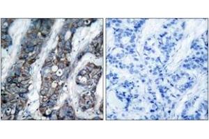 Immunohistochemistry analysis of paraffin-embedded human breast carcinoma, using HER2 (Phospho-Tyr1248) Antibody. (ErbB2/Her2 anticorps  (pTyr1248))