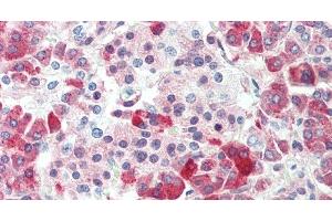 Immunohistochemistry of paraffin-embedded Human gastric cancer using CPB1 Polyclonal Antibody at dilution of 1:60. (CPB1 anticorps)