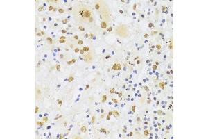 Immunohistochemistry of paraffin-embedded human liver cancer using HNRNPA1 Antibody (ABIN5975570) at dilution of 1/100 (40x lens). (HNRNPA1 anticorps)