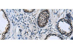Immunohistochemistry of paraffin-embedded Human prost at e cancer tissue using CCAR2 Polyclonal Antibody at dilution of 1:40(x200)