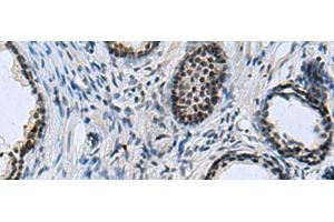 Immunohistochemistry of paraffin-embedded Human prost at e cancer tissue using CCAR2 Polyclonal Antibody at dilution of 1:40(x200) (CCAR2 anticorps)