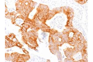 Formalin-fixed, paraffin-embedded human Colorectal Carcinoma stained with Ep-CAM Mouse Monoclonal Antibody (EGP40/1798). (EpCAM anticorps  (Extracellular Domain))