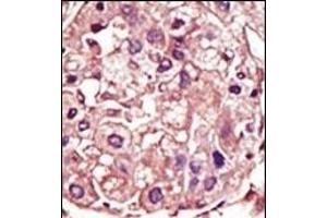 Formalin-fixed and paraffin-embedded human cancer tissue reacted with the primary antibody, which was peroxidase-conjugated to the secondary antibody, followed by AEC staining.
