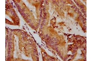 IHC image of ABIN7170939 diluted at 1:400 and staining in paraffin-embedded human endometrial cancer performed on a Leica BondTM system.