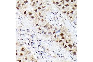 Immunohistochemistry of paraffin-embedded human breast cancer using [KO Validated] CDK4 Rabbit mAb  at dilution of 1:100 (40x lens). (CDK4 anticorps)