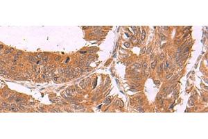 Immunohistochemistry of paraffin-embedded Human colorectal cancer tissue using ZBTB33 Polyclonal Antibody at dilution of 1:30(x200) (ZBTB33 anticorps)
