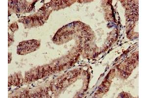 Immunohistochemistry of paraffin-embedded human endometrial cancer using ABIN7171509 at dilution of 1:100