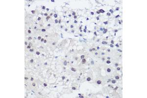 Immunohistochemistry of paraffin-embedded human liver cancer using GA Rabbit pAb (ABIN3022563, ABIN3022564, ABIN3022565, ABIN1679943 and ABIN6218905) at dilution of 1:200 (40x lens).