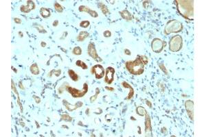 Formalin-fixed, paraffin-embedded human Renal Cell Carcinoma stained with STAT3 Mouse Monoclonal Antibody (STAT3/2409).