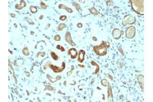 Formalin-fixed, paraffin-embedded human Renal Cell Carcinoma stained with STAT3 Mouse Monoclonal Antibody (STAT3/2409). (STAT3 anticorps)